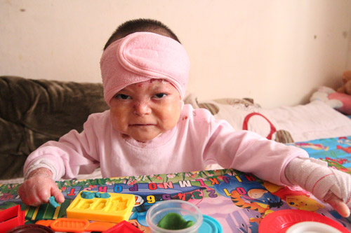 em-be-5-tuoi-nang-10kg-hang-ngay-phai-chiu-nhung-con-dau-giang-xe-tung-mang-da-tho-thit-img_6921.jpg