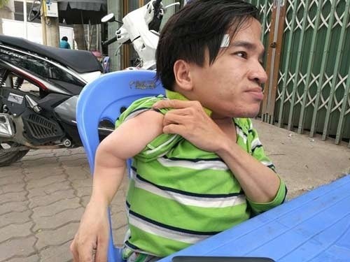 chang-trai-27-tuoi-nang-21kg-mac-benh-quai-ac-vuot-300km-ra-ha-noi-nguyen-hien-xac-2.jpg