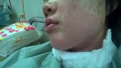 55 qua bong bay phat no co gai tre nhap vien trong tinh trang bong toan bo khuon mat 1.jpg