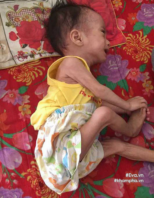 xot-xa-em-be-sinh-ra-nang-4kg-sau-mot-nam-chi-con-34kg-vi-khoi-u-quai-ac-khoi-u1.jpg