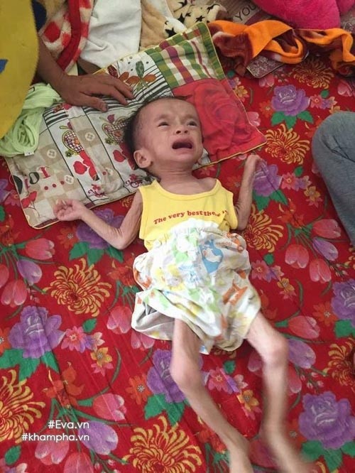 xot-xa-em-be-sinh-ra-nang-4kg-sau-mot-nam-chi-con-34kg-vi-khoi-u-quai-ac-khoi-u2.jpg