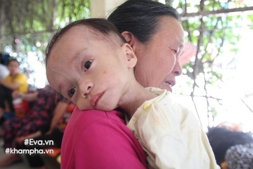 xot-xa-em-be-sinh-ra-nang-4kg-sau-mot-nam-chi-con-34kg-vi-khoi-u-quai-ac-khoi-u4.jpg