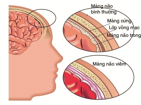 benh viem mang nao mien nui