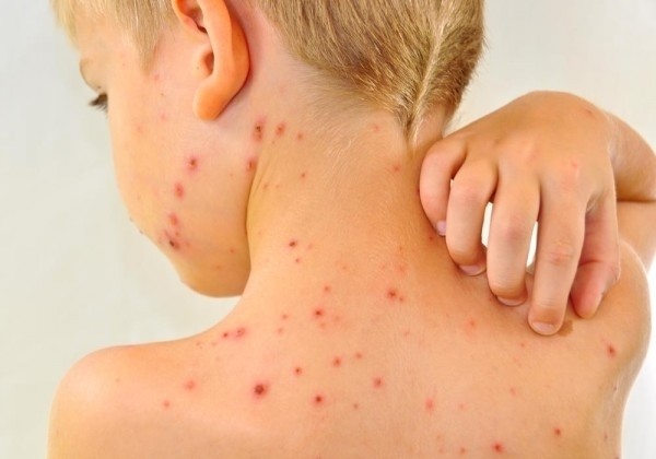 lưng nổi ban đỏ ở trẻ bị sởi