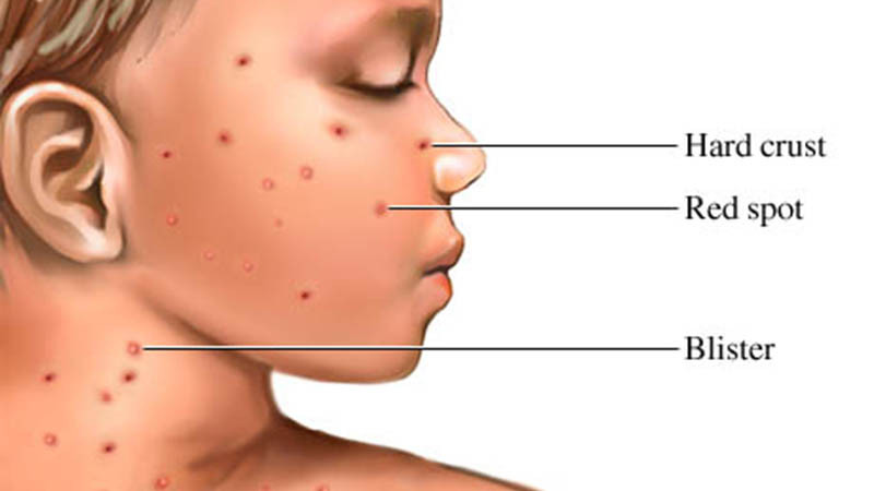 triệu chứng nổi mụn đỏ