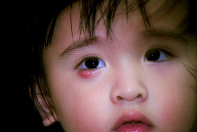 bé gái bị sưng mụn mắt