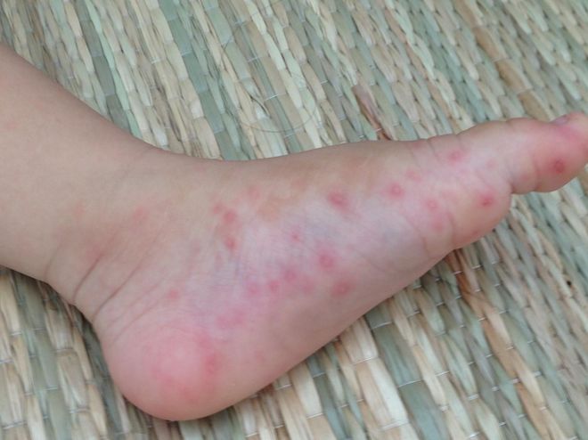chấm đỏ trẻ sốt xuất huyết