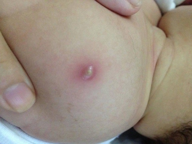 tiêm phòng lao cho trẻ sơ sinh