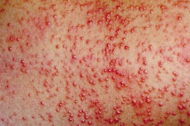 biến chứng rôm sảy