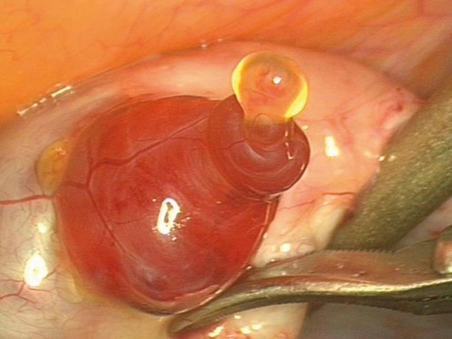 Rụng trứng là hiện tượng của phụ nữ