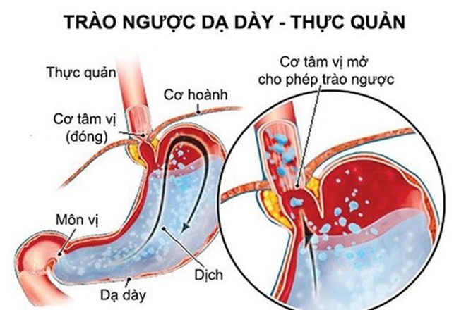 trao nguoc da day thuc quan