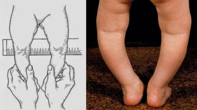 chân vòng kiềng ở trẻ sơ sinh