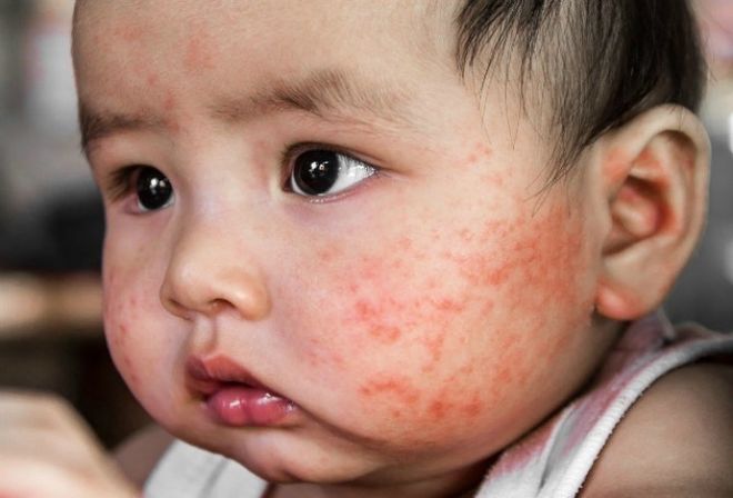bé viêm da dị ứng