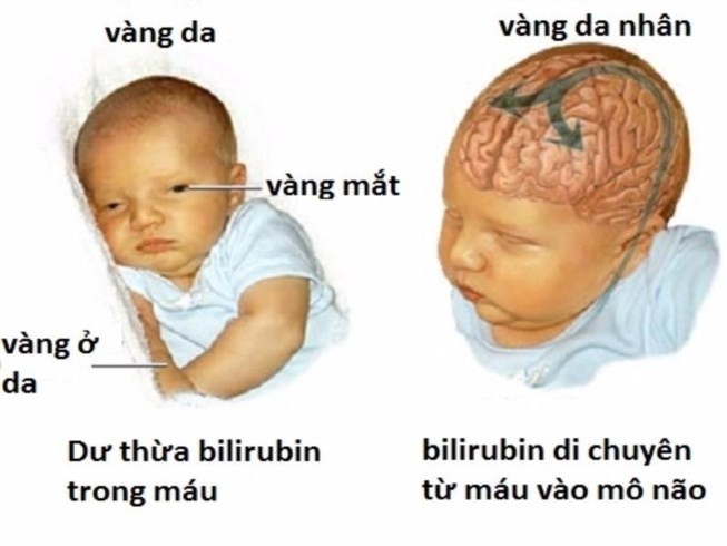 phân biệt vàng da