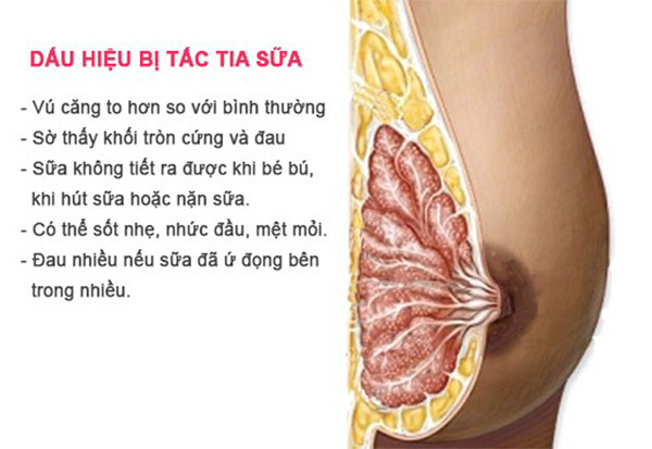 dấu hiệu bị tắc tia sữa