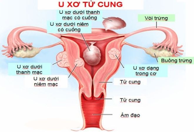 U xơ tử cung được gọi là u nhưng là khối u lành tính ít gây biến chứng ung thư