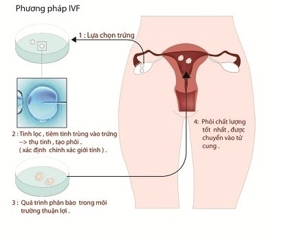 Thụ tinh nhân tạo có thể được tiến hành để hỗ trợ