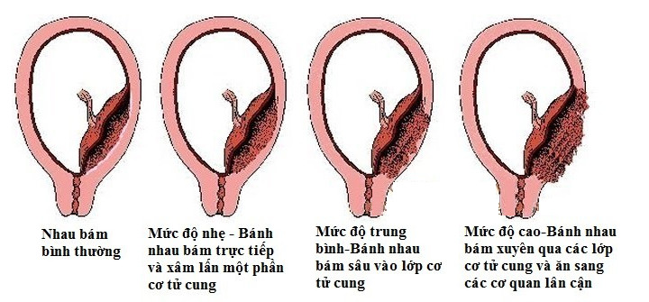 Nhau cài răng lược là một biến chứng phổ biến của mang thai sớm sau sinh mổ.
