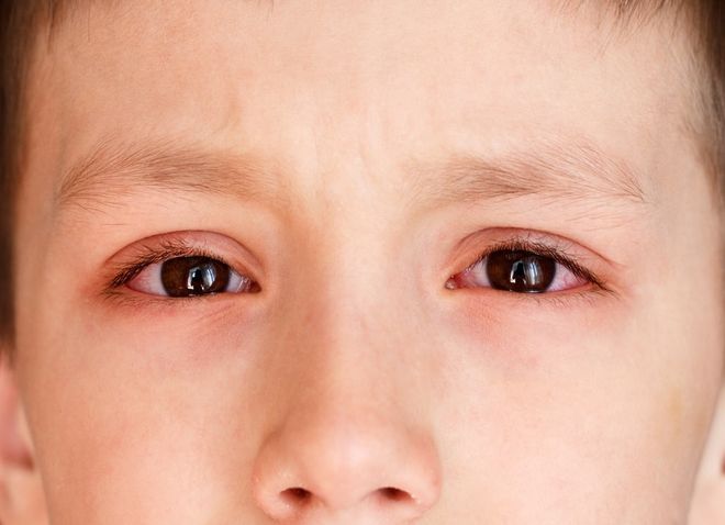 bé trai bị đau mắt hột