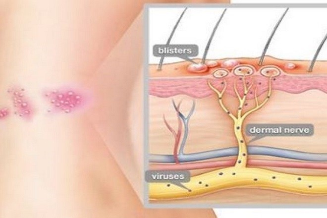 cấu trúc bệnh zona
