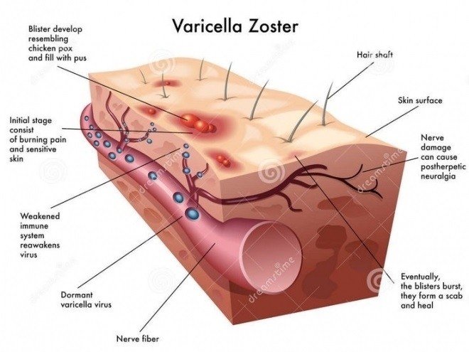 cấu trúc của bệnh zona