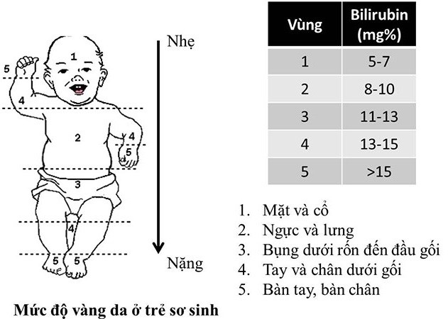 mức độ vàng da ở bé
