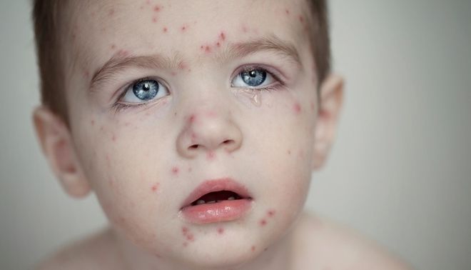 bé mắc bệnh sởi