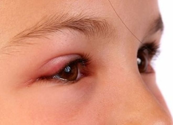 Bệnh viêm kết mạc mắt ở trẻ em là một bệnh dễ lây lan qua đường hô hấp