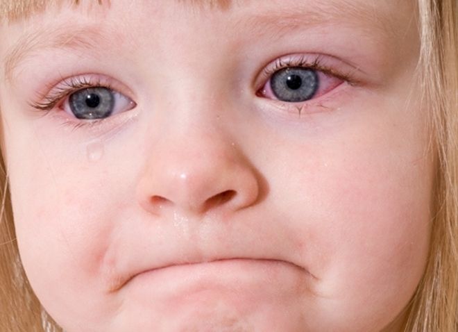 Trẻ bị viêm kết mạc mắt thường có biểu hiện đỏ mắt, ngứa mắt và mí mắt sưng phù