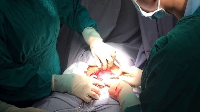 Nước ối nhiều khiến mẹ phải sinh mổ