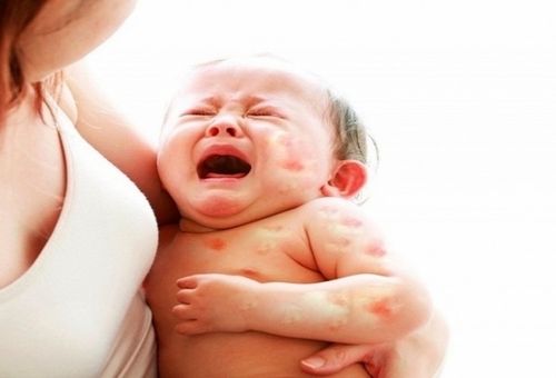 bé quấy khóc vì bị nổi mụn nhọt