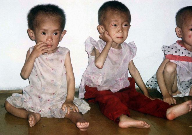 trẻ bị suy dinh dưỡng