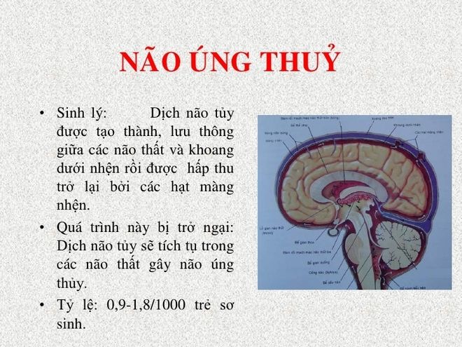 não úng thủy là triệu chứng giãn não thất ở trẻ sơ sinh