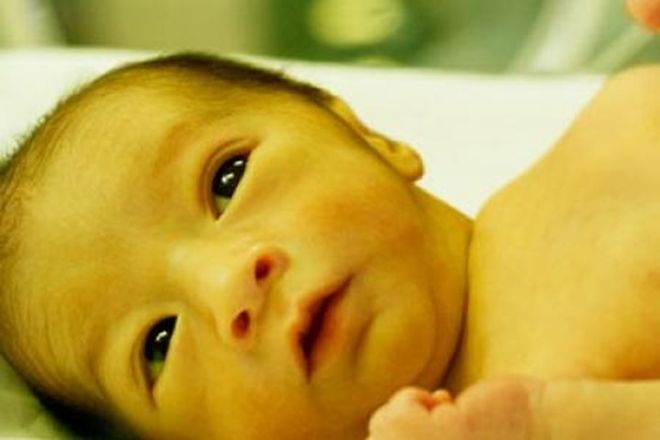 vàng da ở trẻ sơ sinh làm giảm thị giác của bé