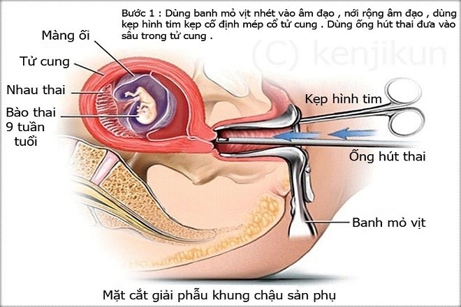 mô phỏng đưa dụng cụ phá thai vào bên trong