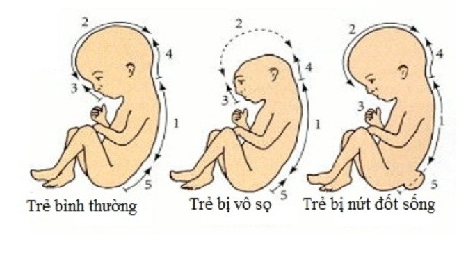 thai nhi bị dị tật do thiết axit folic