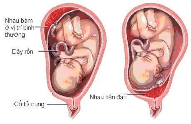 hiện tượng nhau tiền đạo