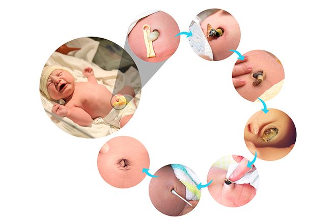 quy trình chăm sóc rốn cho trẻ sơ sinh