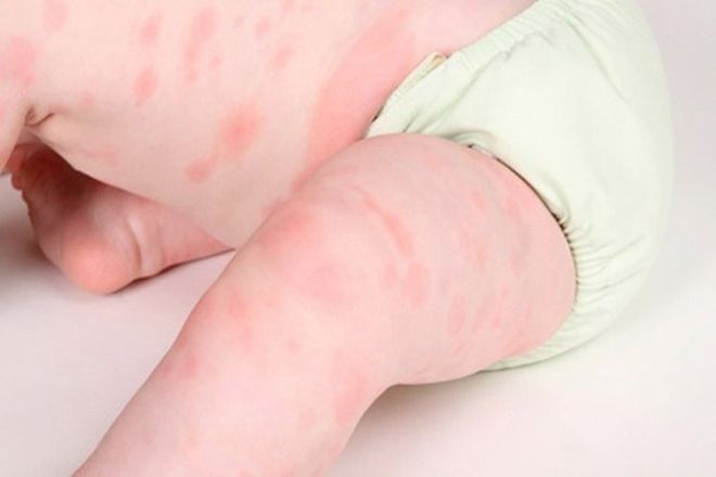 bé bị rôm sảy