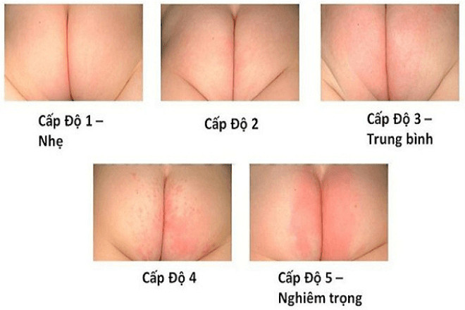 các cấp độ hăm da ở trẻ sơ sinh
