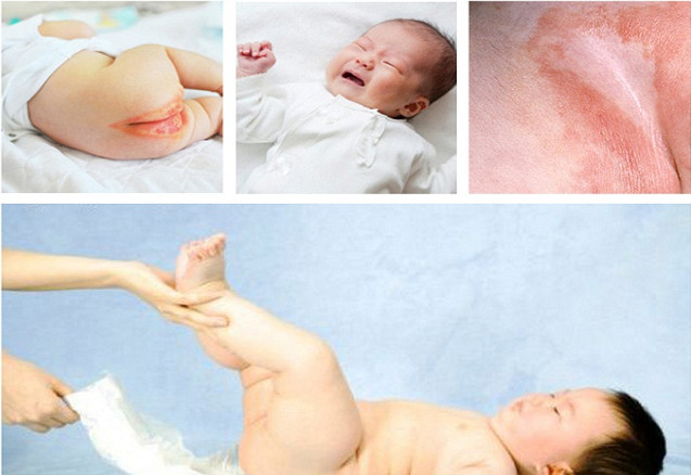 vệ sinh cho bé sạch sẽ để không bị hăm tã