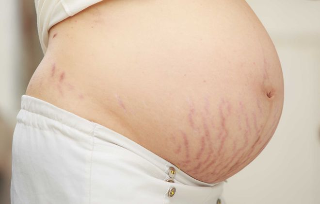 bà bầu bị rạn da