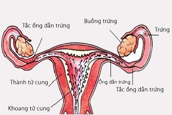 hút thai gây tắc vòi dẫn trứng