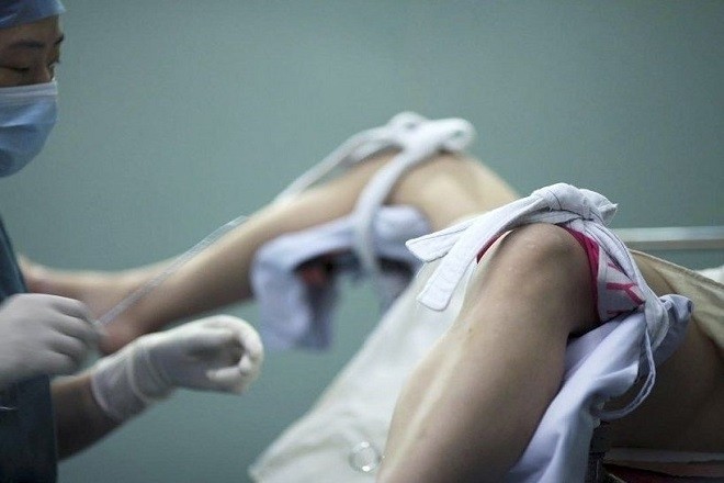 bác sĩ chuẩn bị hút thai