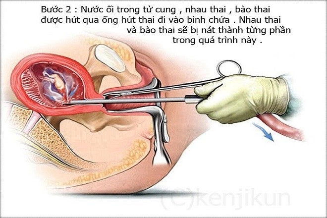 mô phỏng kĩ thuật nạo hút thai