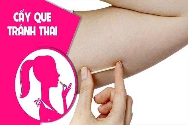 que cấy tránh thai được nhiều phụ nữ ưa chuộng