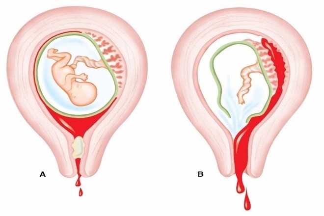 mô phỏng hút thai bị sót