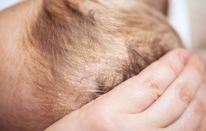 cứt trâu đóng vảy trên đầu bé