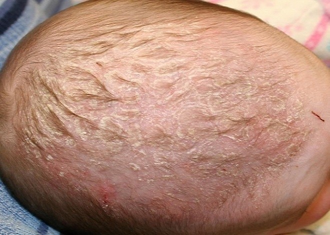 cứt trân trên đầu trẻ