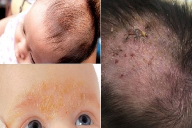 đầu bé nhiều cứt trâu